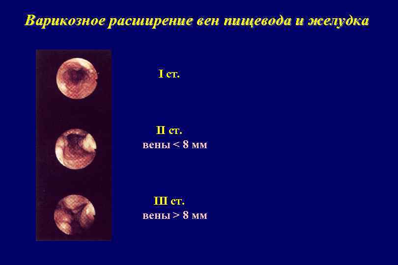 Варикозное расширение вен пищевода и желудка I ст. II ст. вены < 8 мм