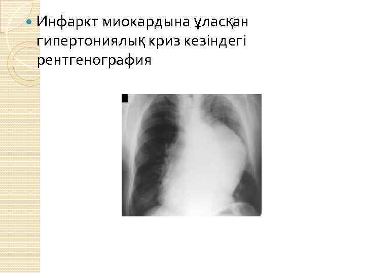  Инфаркт миокардына ұласқан гипертониялық криз кезіндегі рентгенография 