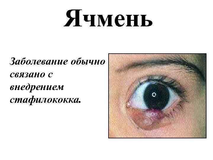 Ячмень Заболевание обычно связано с внедрением стафилококка. 