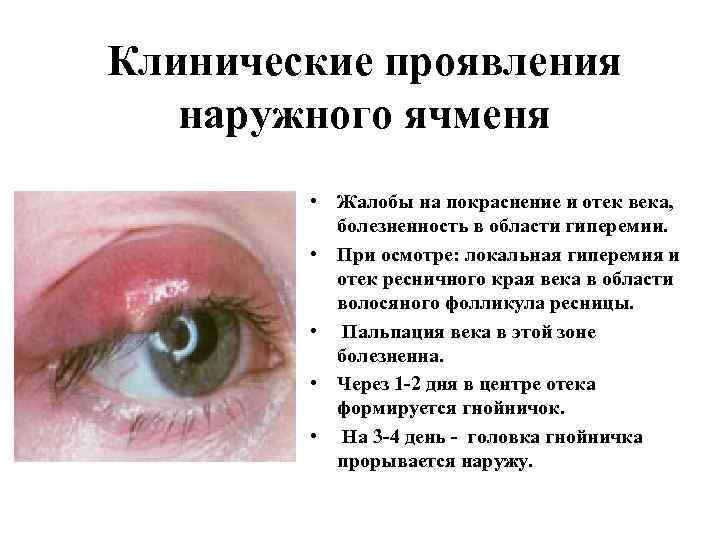 Клинические проявления наружного ячменя • Жалобы на покраснение и отек века, болезненность в области
