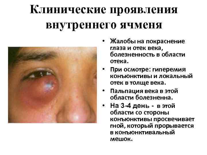 Клинические проявления внутреннего ячменя • Жалобы на покраснение глаза и отек века, болезненность в