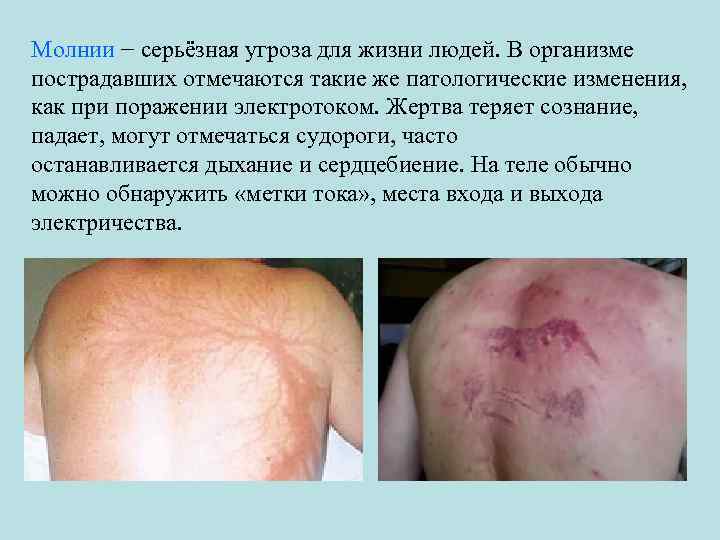 Молнии − серьёзная угроза для жизни людей. В организме пострадавших отмечаются такие же патологические