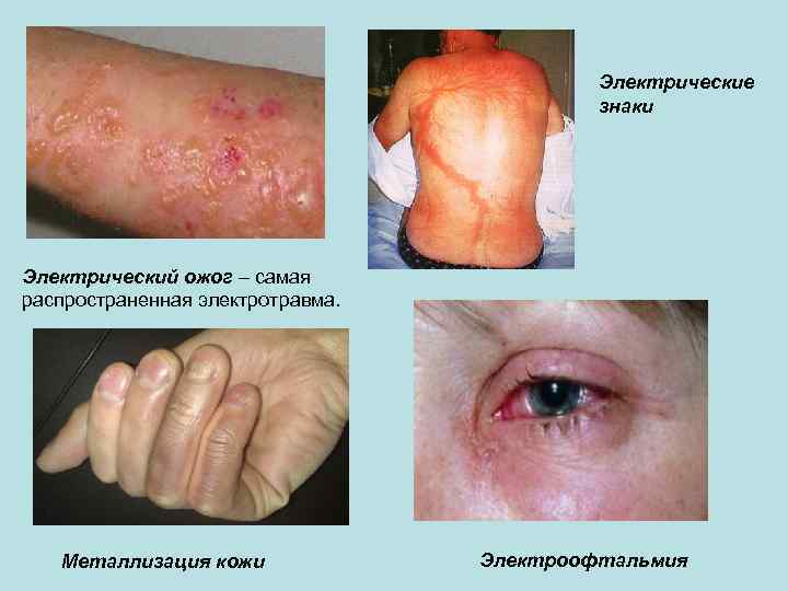 Электрические знаки Электрический ожог – самая распространенная электротравма. Металлизация кожи Электроофтальмия 