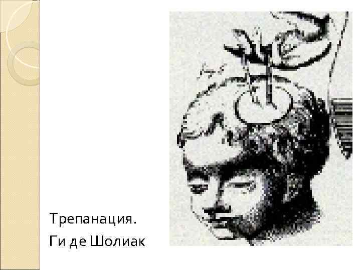 Трепанация. Ги де Шолиак 