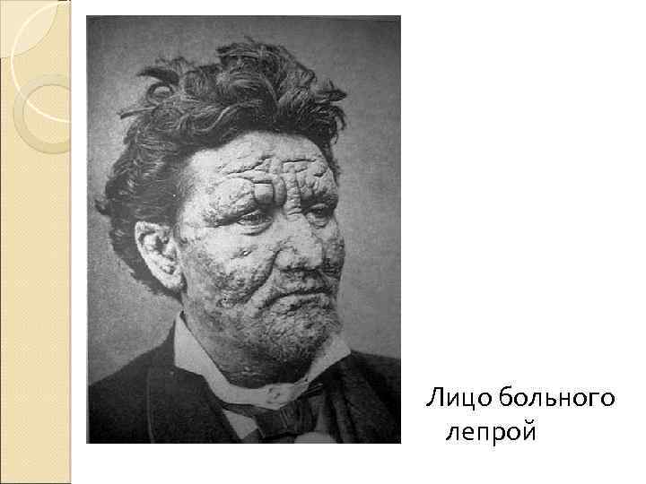 Лицо больного лепрой 