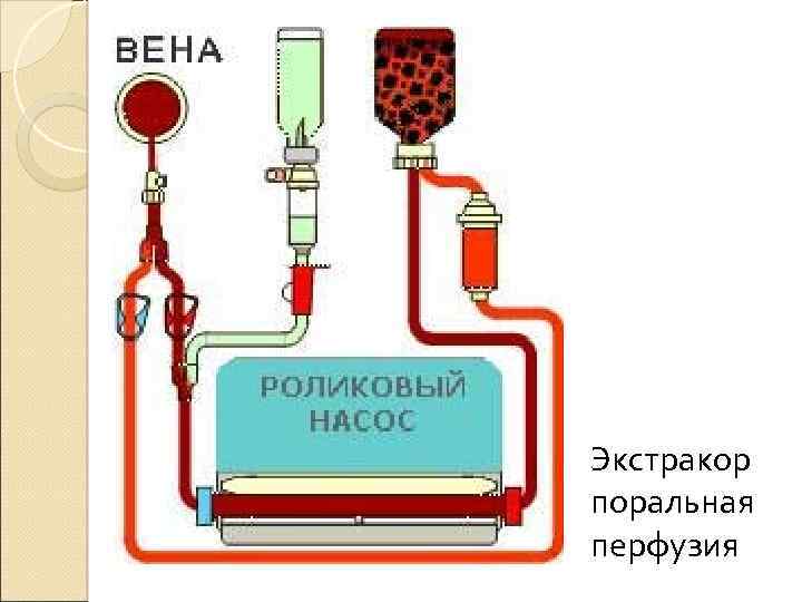 Экстракор поральная перфузия 