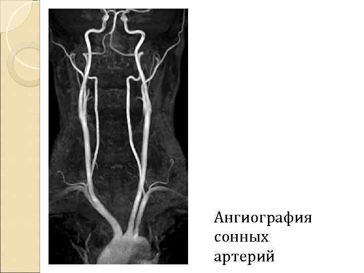 Ангиография сонных артерий 