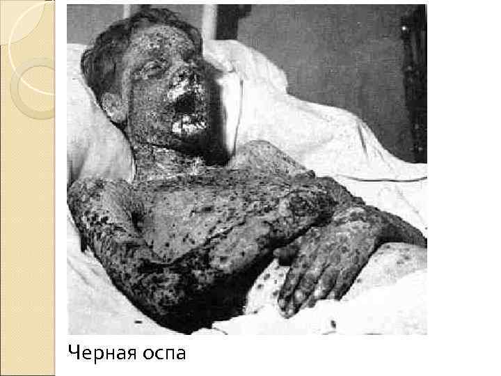 Черная оспа 