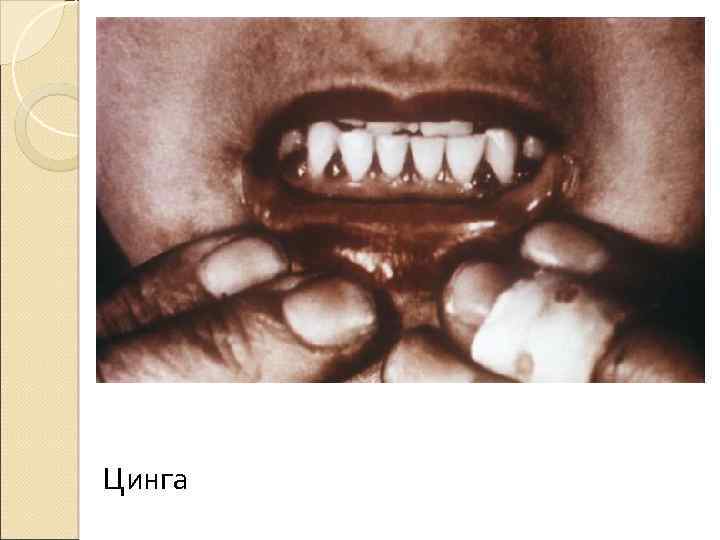 Цинга 