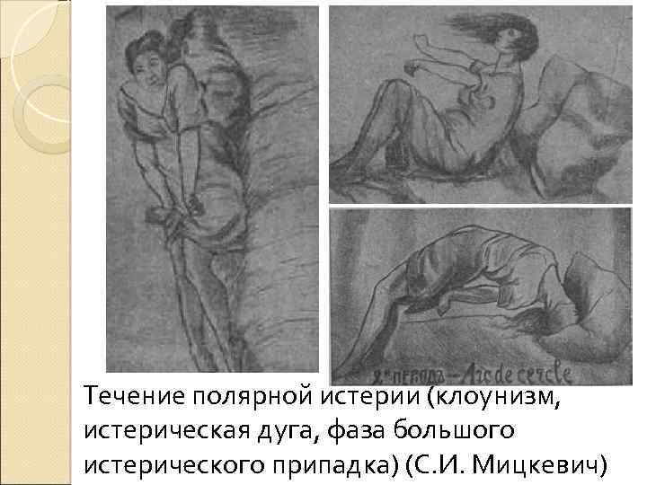 Течение полярной истерии (клоунизм, истерическая дуга, фаза большого истерического припадка) (С. И. Мицкевич) 