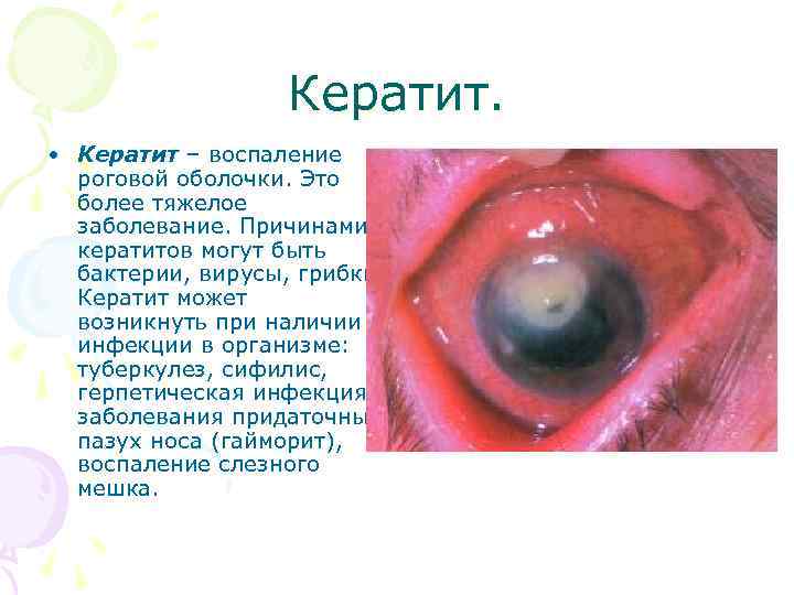 Кератит. • Кератит – воспаление роговой оболочки. Это более тяжелое заболевание. Причинами кератитов могут