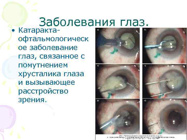 Заболевания глаз. • Катаракта- офтальмологическ ое заболевание глаз, связанное с помутнением хрусталика глаза и