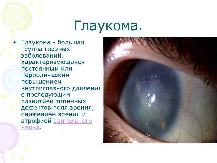 Глаукома. • Глаукома - большая группа глазных заболеваний, характеризующаяся постоянным или периодическим повышением внутриглазного
