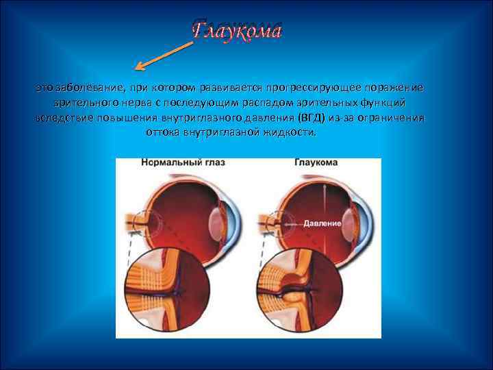 Глаукома это заболевание, при котором развивается прогрессирующее поражение зрительного нерва с последующим распадом зрительных