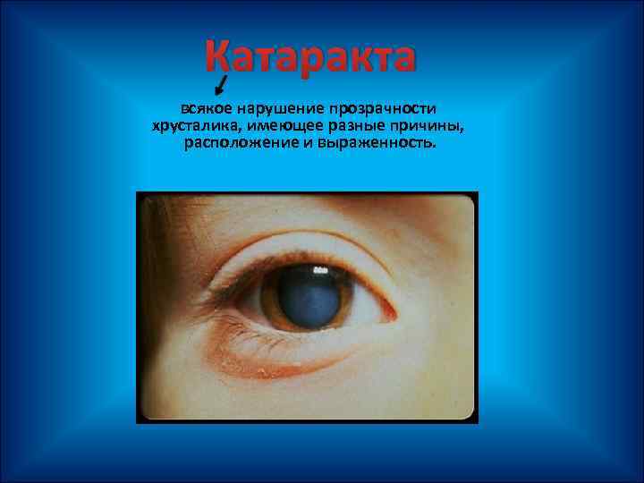 Катаракта всякое нарушение прозрачности хрусталика, имеющее разные причины, расположение и выраженность. 
