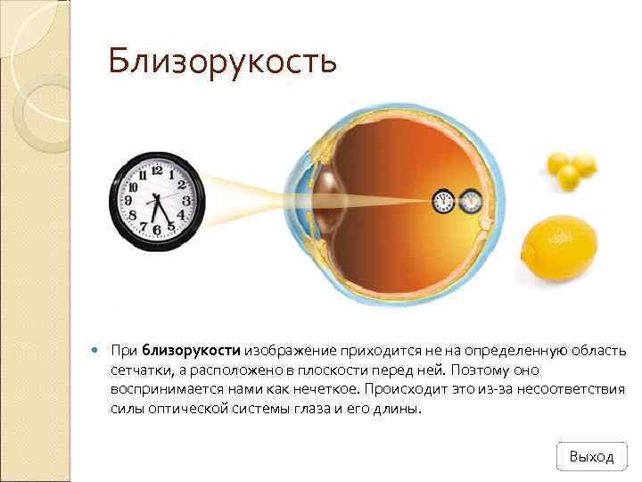 Близорукость При близорукости изображение приходится не на определенную область сетчатки, а расположено в плоскости