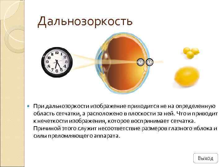 Дальнозоркость При дальнозоркости изображение приходится не на определенную область сетчатки, а расположено в плоскости