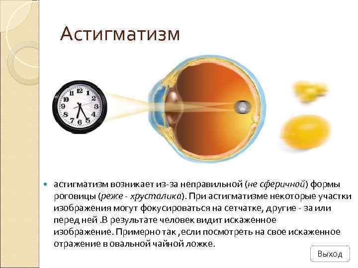 Астигматизм астигматизм возникает из-за неправильной (не сферичной) формы роговицы (реже - хрусталика). При астигматизме