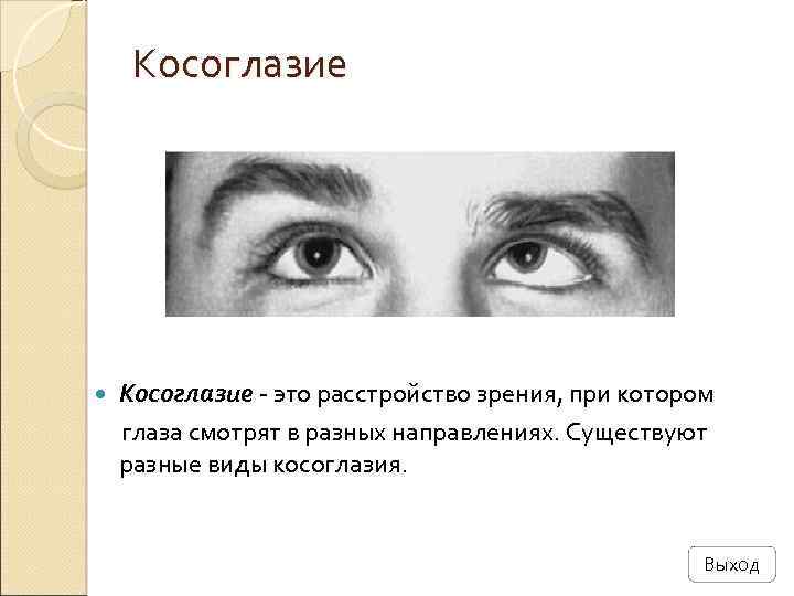  Косоглазие - это расстройство зрения, при котором глаза смотрят в разных направлениях. Существуют