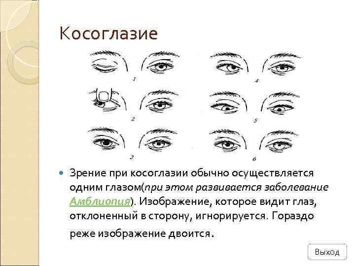 Косоглазие Зрение при косоглазии обычно осуществляется одним глазом(при этом развивается заболевание Амблиопия). Изображение, которое