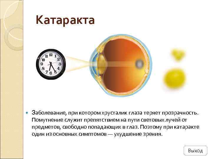 Катаракта Заболевание, при котором хрусталик глаза теряет прозрачность. Помутнение служит препятствием на пути световых