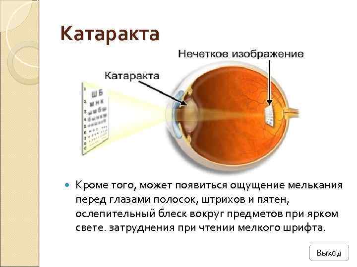 Катаракта Кроме того, может появиться ощущение мелькания перед глазами полосок, штрихов и пятен, ослепительный