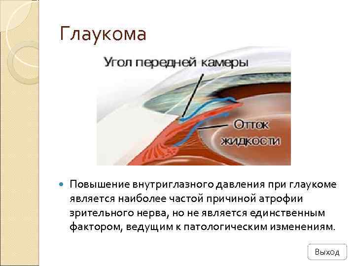 Глаукома Повышение внутриглазного давления при глаукоме является наиболее частой причиной атрофии зрительного нерва, но