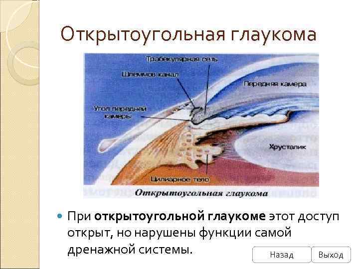 Открытоугольная глаукома При открытоугольной глаукоме этот доступ открыт, но нарушены функции самой дренажной системы.