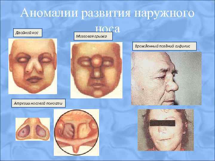 Аномалии развития наружного носа Двойной нос Мозговая грыжа Врожденный поздний сифилис Атрезии носовой полости