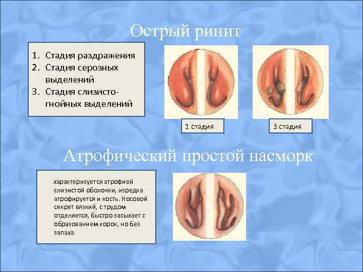 Острый ринит 1. Стадия раздражения 2. Стадия серозных выделений 3. Стадия слизистогнойных выделений 1