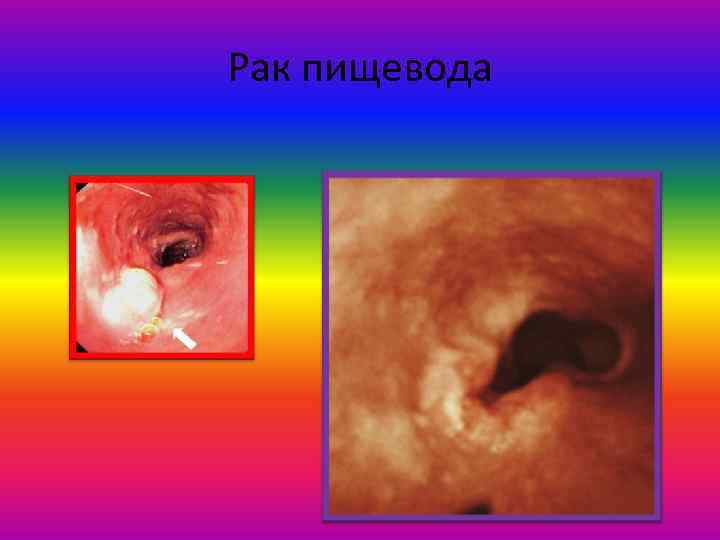 Рак пищевода 