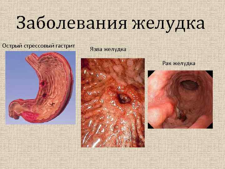 Заболевания желудка Острый стрессовый гастрит Язва желудка Рак желудка 