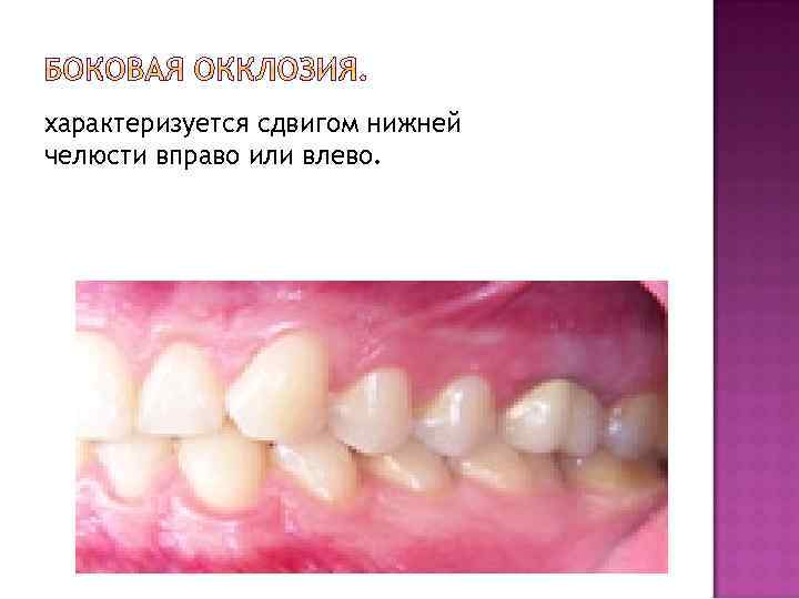 характеризуется сдвигом нижней челюсти вправо или влево. 
