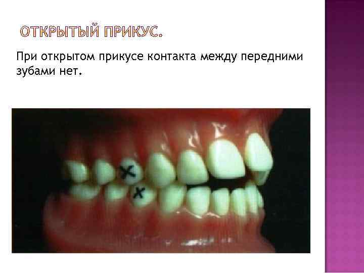 При открытом прикусе контакта между передними зубами нет. 