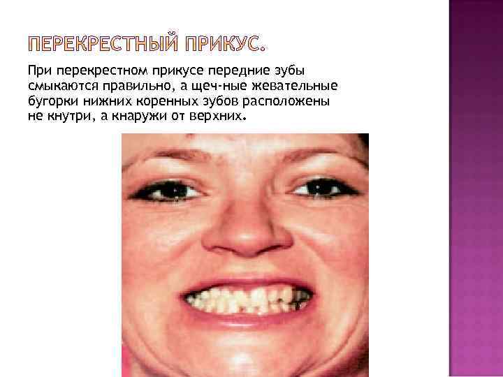 При перекрестном прикусе передние зубы смыкаются правильно, а щеч ные жевательные бугорки нижних коренных