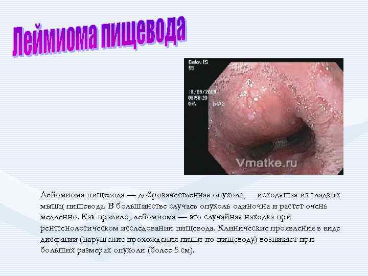 Лейомиома пищевода — доброкачественная опухоль, исходящая из гладких мышц пищевода. В большинстве случаев опухоль