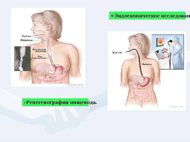  • Эндоскопическое исследован • Рентгенография пищевода. 