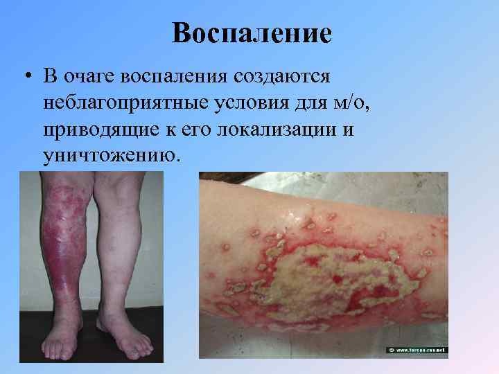 Воспаление • В очаге воспаления создаются неблагоприятные условия для м/о, приводящие к его локализации