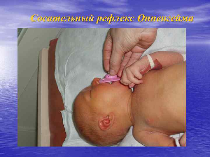 Сосательный рефлекс Оппенгейма 