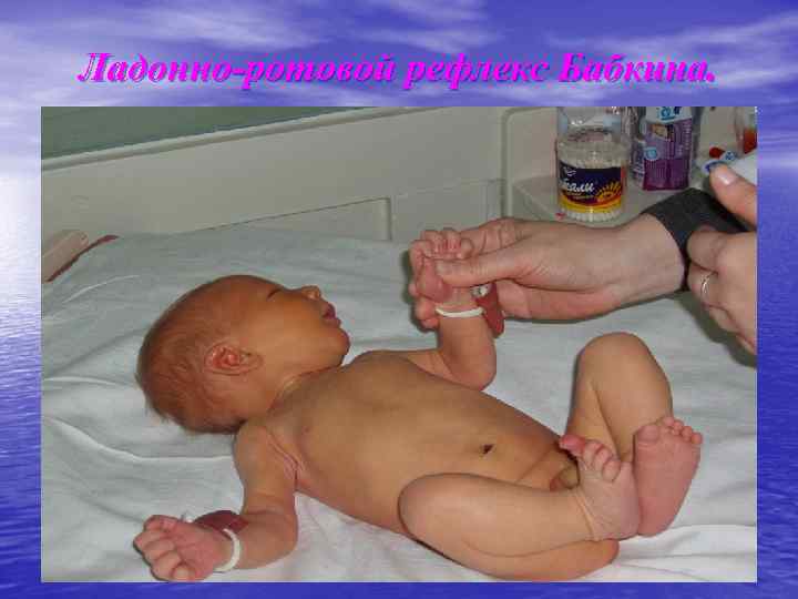 Ладонно-ротовой рефлекс Бабкина. 