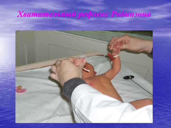 Хватательный рефлекс Робинзона 