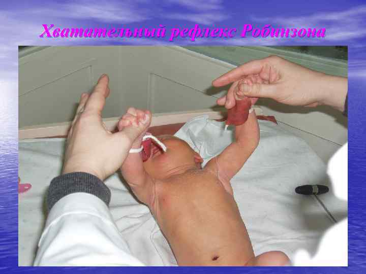 Хватательный рефлекс Робинзона 
