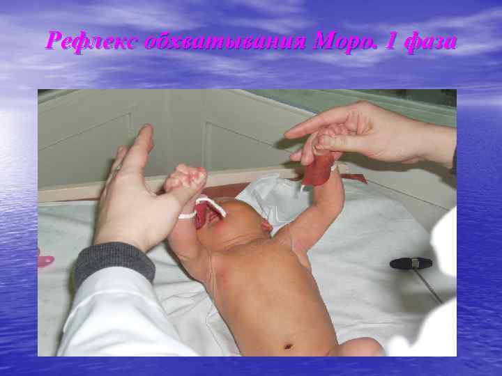 Рефлекс обхватывания Моро. 1 фаза 