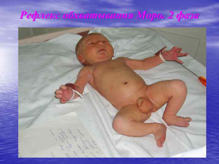 Рефлекс обхватывания Моро. 2 фаза 