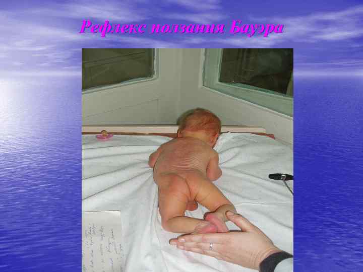 Рефлекс ползания Бауэра 