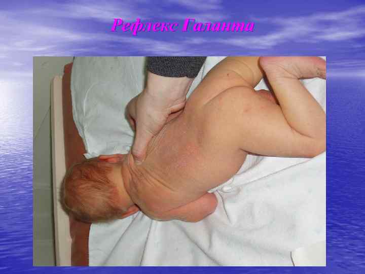 Рефлекс Галанта 