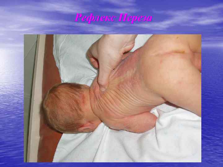 Рефлекс Переза 