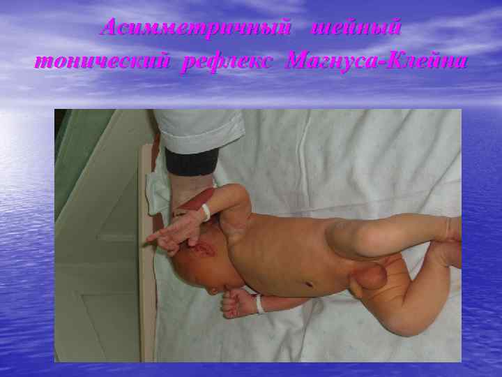 Асимметричный шейный тонический рефлекс Магнуса-Клейна 