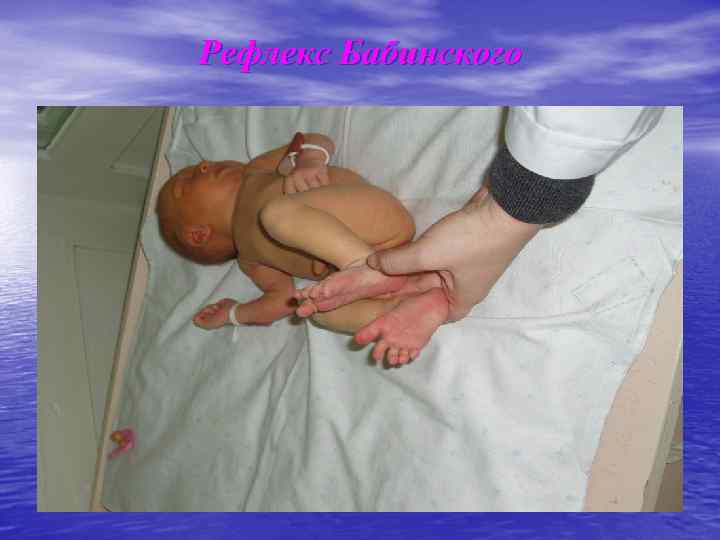 Рефлекс Бабинского 