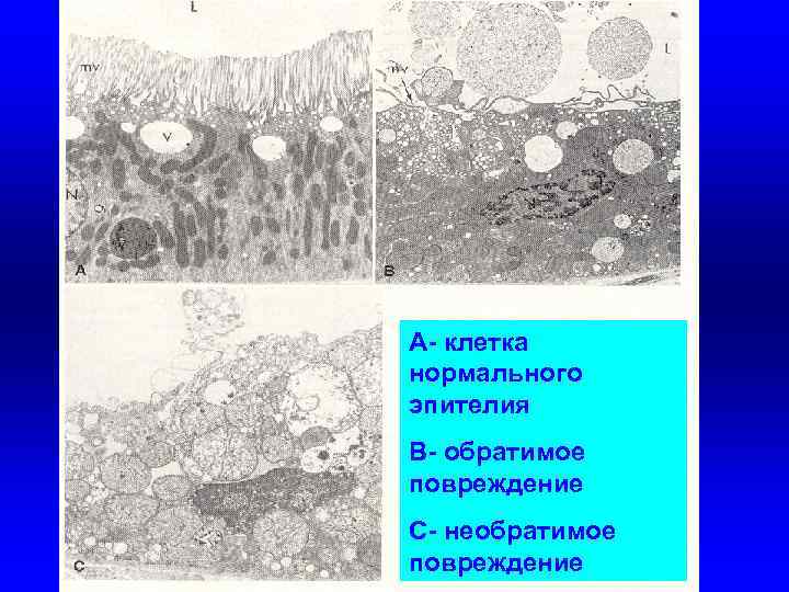 А- клетка нормального эпителия В- обратимое повреждение С- необратимое повреждение 